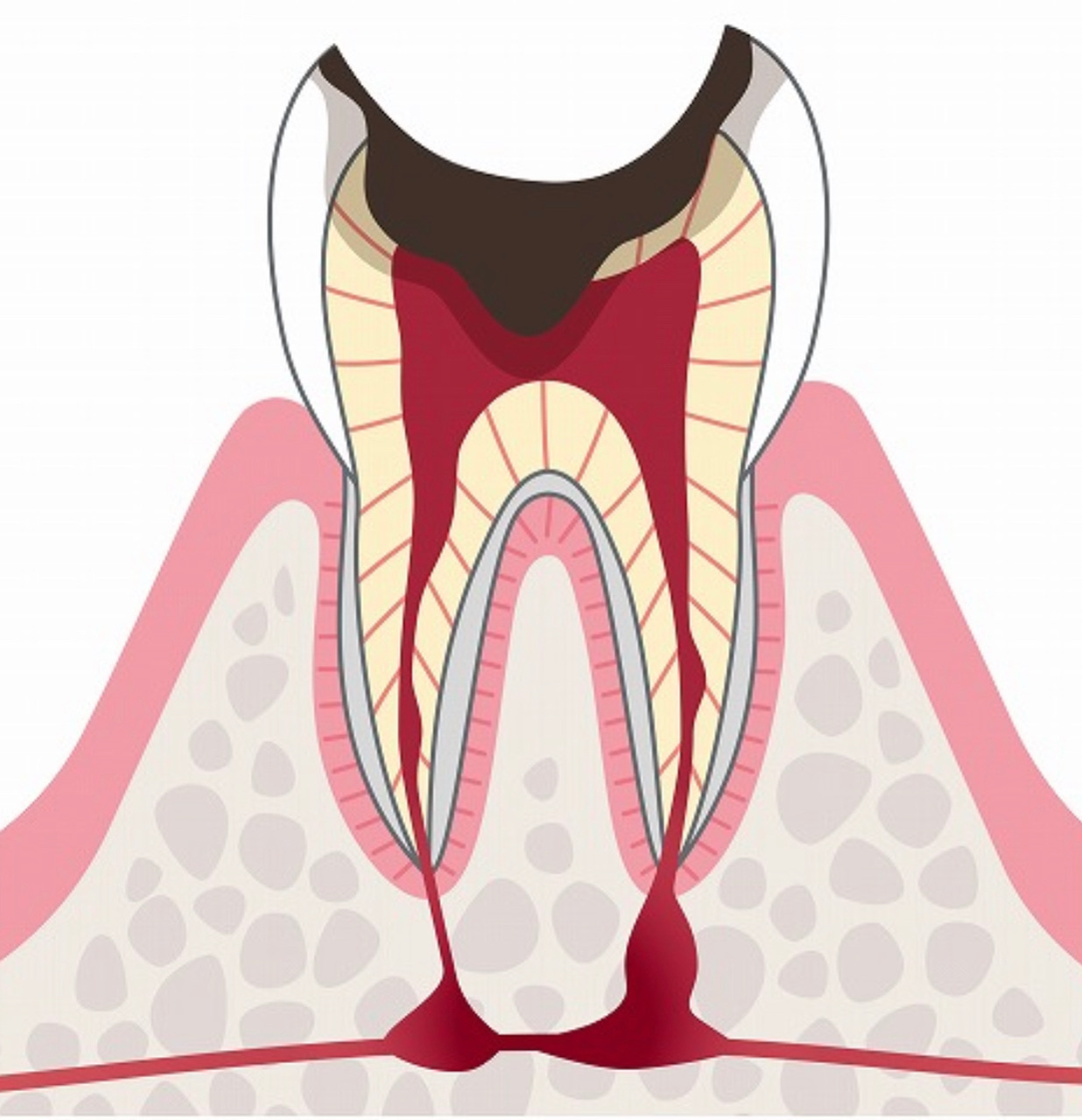 C4の虫歯の画像